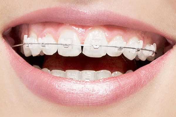 Clear aligners